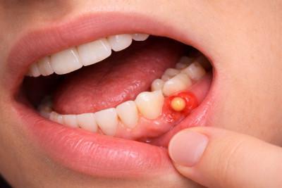 Emergency dental abscess drainage in Laval