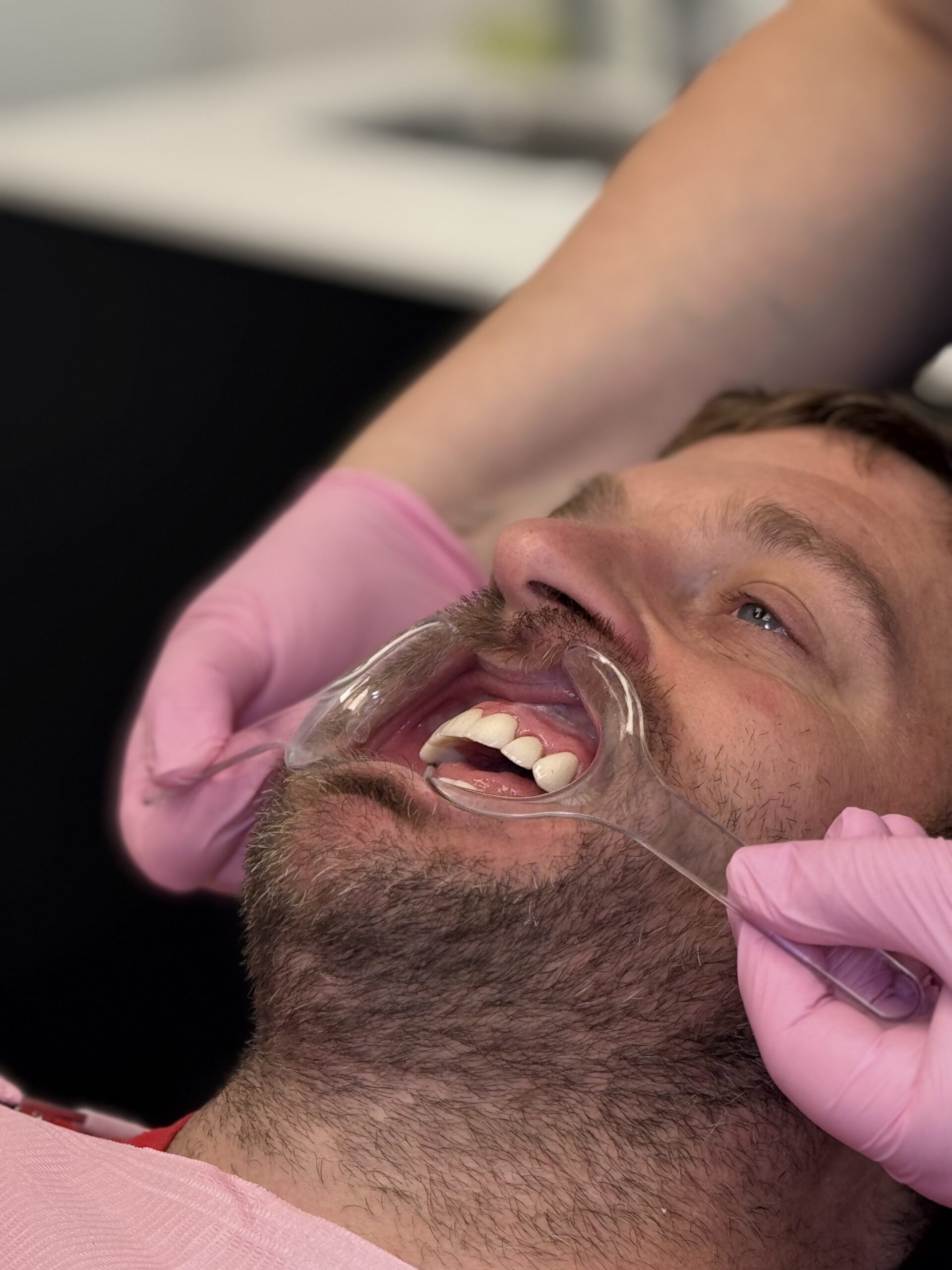 Plaque occlusale pour bruxeurs à Laval — Smile Boutik